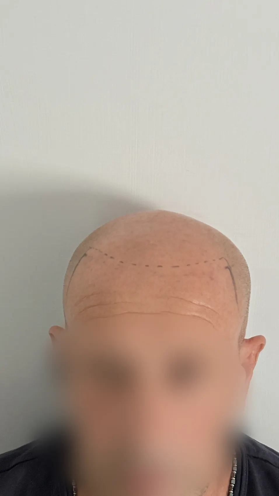 Attaccatura tratteggiata a pennarello sulla fronte di un cliente