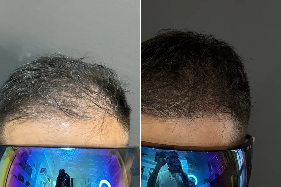 Prima e dopo: effetto densità sui capelli radi