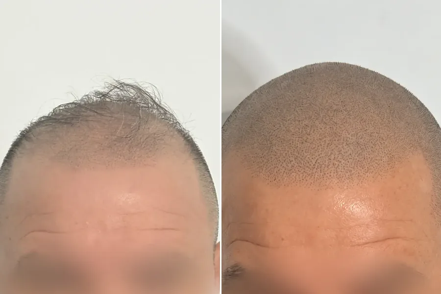 Prima e dopo: effetto rasato